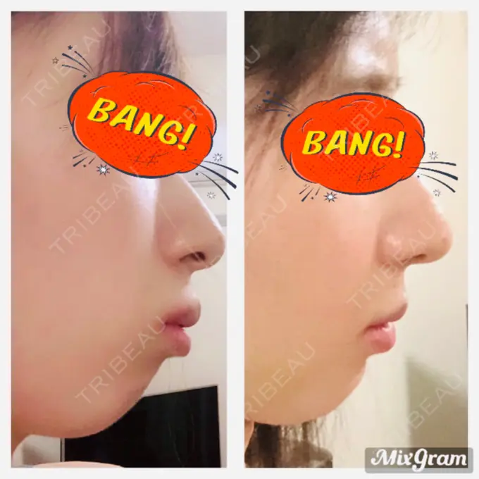 セットバック カトレア歯科・美容クリニック DAY 16 メイン用