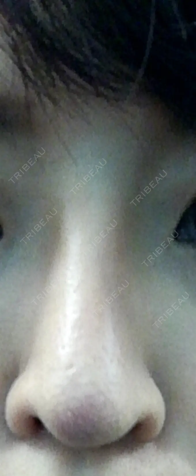 隆鼻術 / 鼻尖形成（切開） / 軟骨移植 ヤスミクリニック DAY 16 メイン用