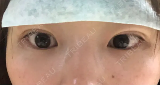 二重埋没 湘南美容クリニック 長野院 DAY 0 メイン用