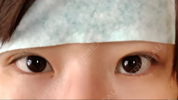 二重埋没 湘南美容クリニック 長野院 DAY 1 メイン用