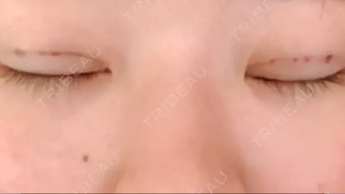 二重埋没 湘南美容クリニック 長野院 DAY 1 メイン用