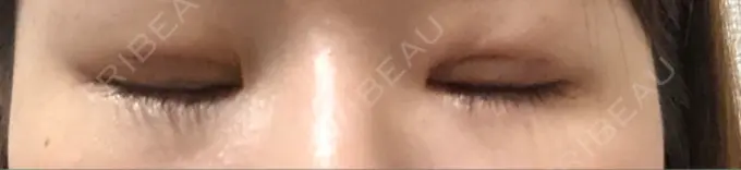 二重埋没 湘南美容クリニック 長野院 DAY 2 メイン用