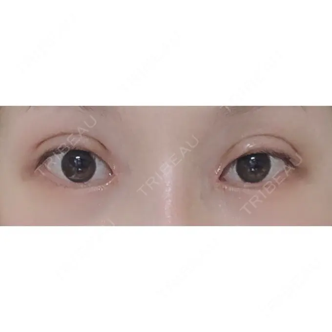 二重切開 / 目頭切開 / 上まぶたの脂肪取り / 蒙古ひだ形成 FROM B整形外科 (旧バウム整形外科) DAY 27 メイン用