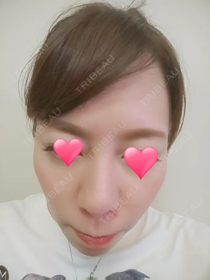 隆鼻術 品川スキンクリニック岡山院 DAY 44 メイン用