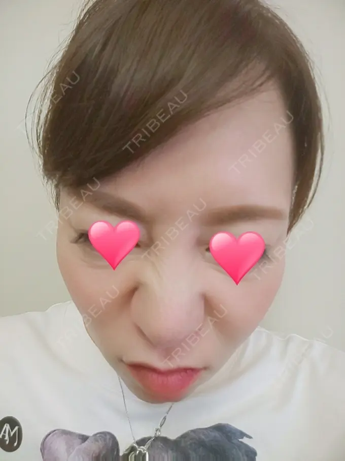 隆鼻術 品川スキンクリニック岡山院 DAY 44 メイン用