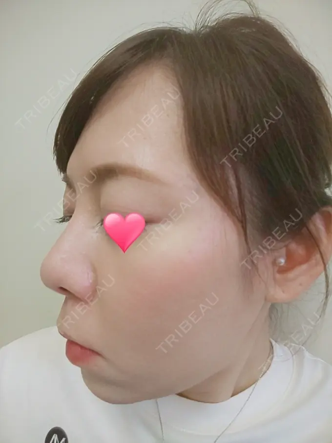 隆鼻術 品川スキンクリニック岡山院 DAY 44 メイン用