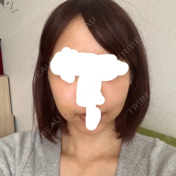 バッカルファット除去 / 脂肪吸引（顔） / ハイフ（顔） THE PLAN（ザ・プラン）美容整形外科・皮膚科 DAY 11 メイン用