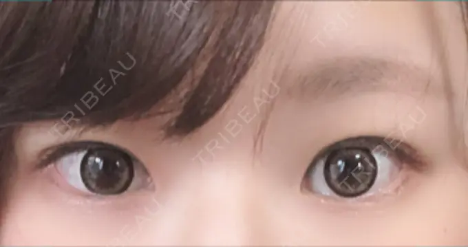 二重埋没 湘南美容クリニック 長野院 AFTER メイン用