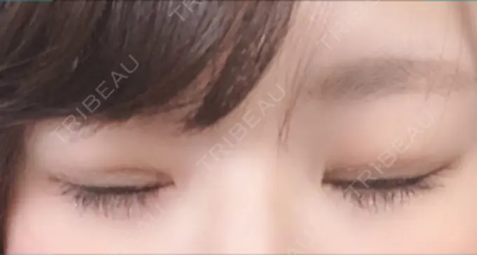 二重埋没 湘南美容クリニック 長野院 DAY 3 メイン用