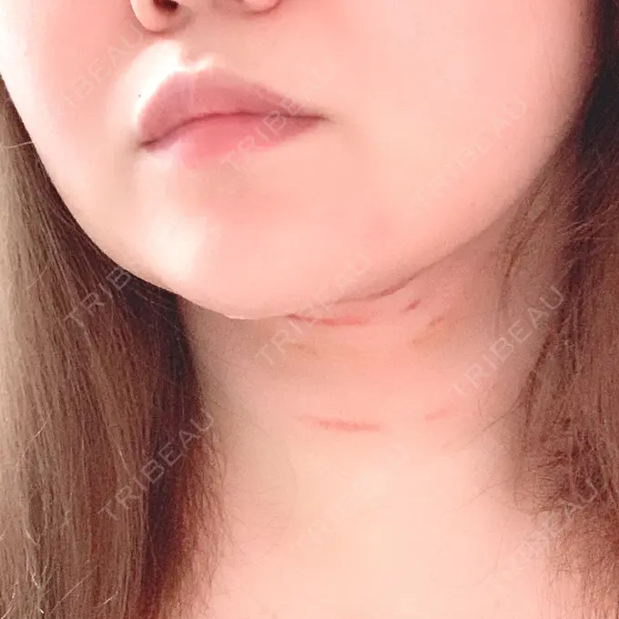 その他（目元） THE CLINIC（ザ・クリニック） 福岡院 DAY 3 メイン用