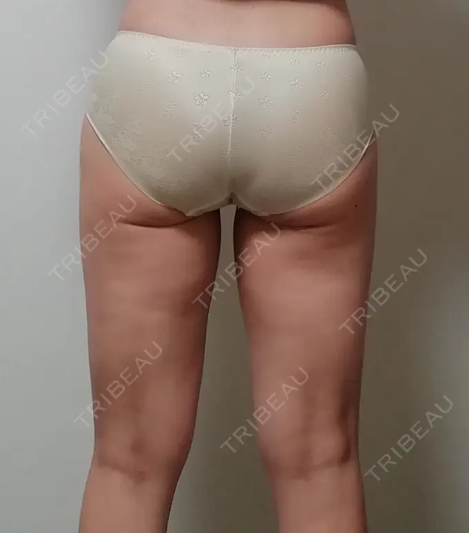 脂肪吸引（脚） THE CLINIC（ザ・クリニック） 名古屋院 DAY 51 メイン用