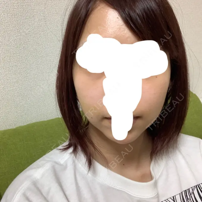 バッカルファット除去 / 脂肪吸引（顔） / ハイフ（顔） THE PLAN（ザ・プラン）美容整形外科・皮膚科 DAY 12 メイン用