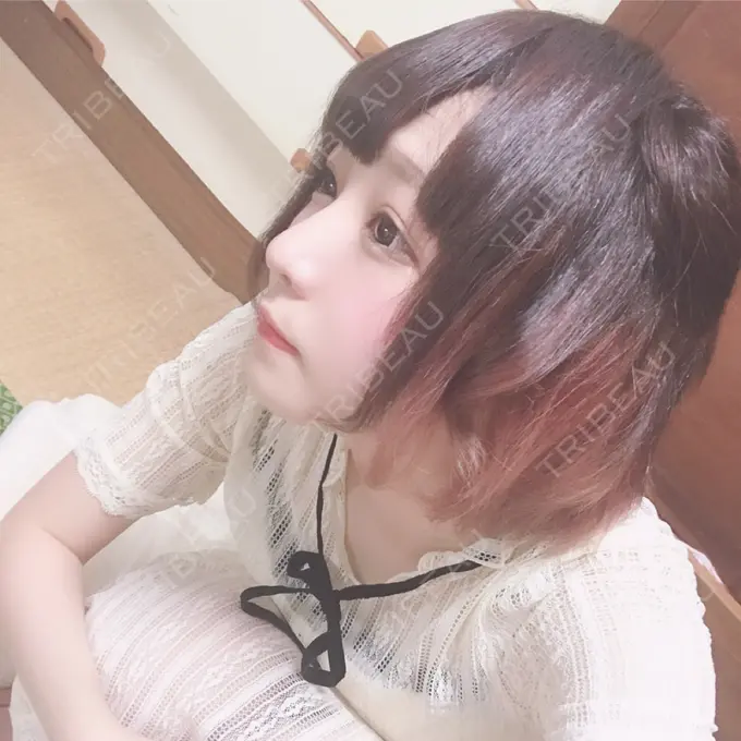 隆鼻術 / 鼻中隔延長（切開） / 鼻孔縁挙上 プリモ麻布十番クリニック DAY 114 メイン用