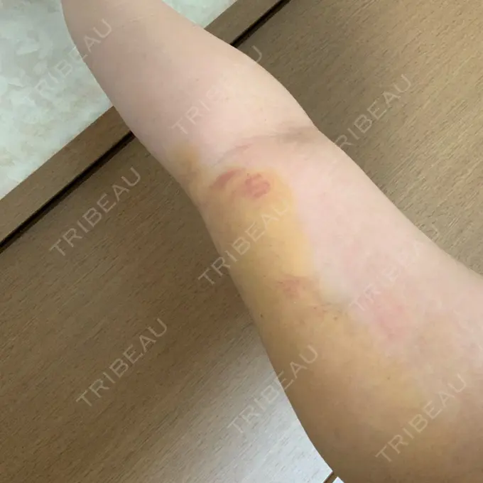 その他（目元） THE CLINIC（ザ・クリニック） 福岡院 DAY 5 メイン用