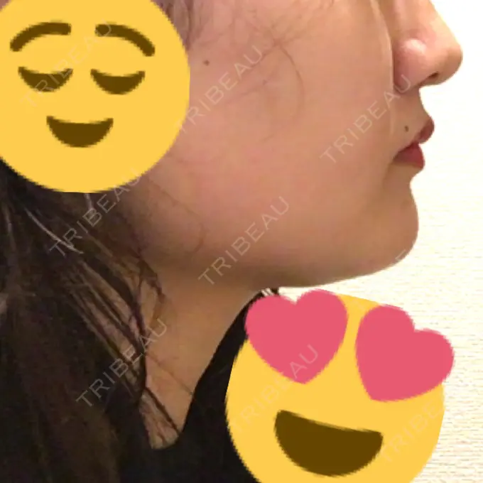 脂肪吸引（顔） アサミ美容外科 渋谷院 DAY 61 メイン用