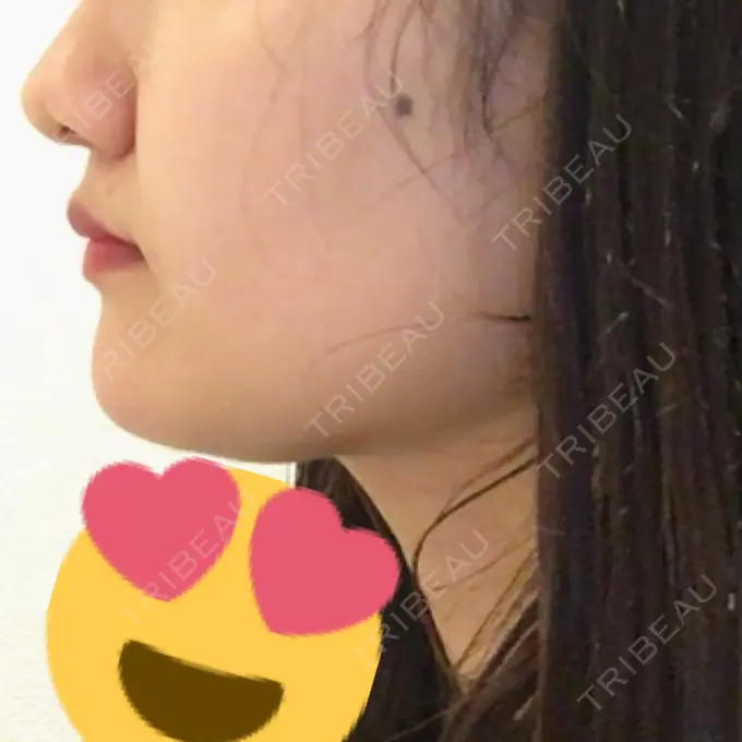 脂肪吸引（顔） アサミ美容外科 渋谷院 DAY 61 メイン用