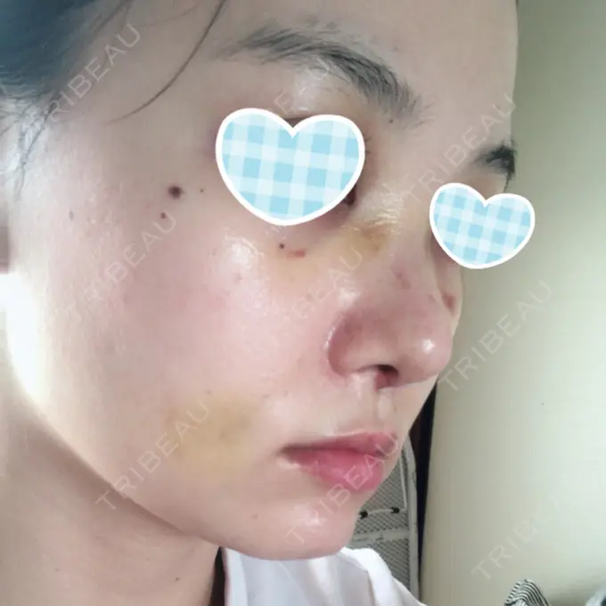 隆鼻術 / 鼻尖形成（切開） / 鼻中隔延長（切開） / 軟骨移植 / 鼻修正 / 鼻孔縁下降 エートップ美容整形外科 DAY 8 メイン用