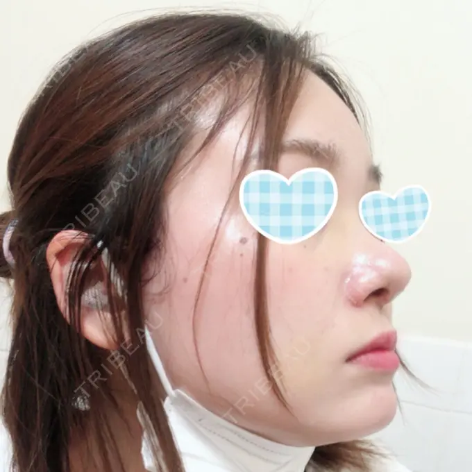 隆鼻術 / 鼻尖形成（切開） / 鼻中隔延長（切開） / 軟骨移植 / 鼻修正 / 鼻孔縁下降 エートップ美容整形外科 DAY 9 メイン用