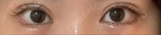 ヒアルロン酸注入（涙袋） リエンジャン整形外科 江南店 AFTER メイン用