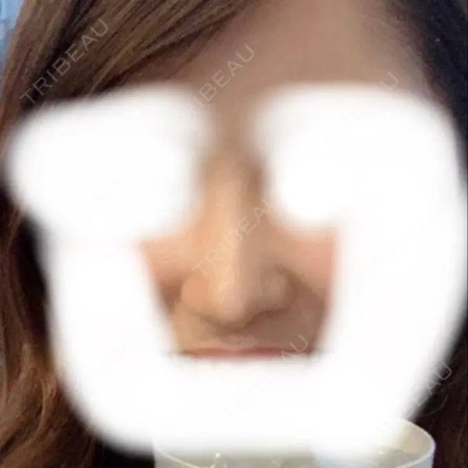 鼻尖形成（切開） / 鼻中隔延長（切開） / 軟骨移植 / 骨切幅寄せ / ワシ鼻修正・ハンプ切除 / 鼻尖縮小 / その他（鼻） ラミチェ美容整形外科 DAY 88 メイン用