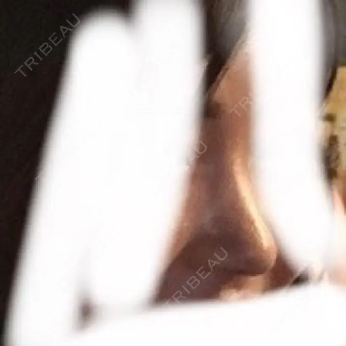 鼻尖形成（切開） / 鼻中隔延長（切開） / 軟骨移植 / 骨切幅寄せ / ワシ鼻修正・ハンプ切除 / 鼻尖縮小 / その他（鼻） ラミチェ美容整形外科 DAY 88 メイン用