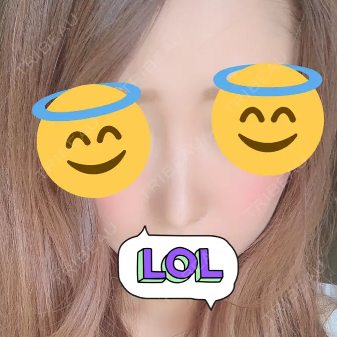 鼻尖形成（切開） / 鼻中隔延長（切開） / 軟骨移植 / 骨切幅寄せ / ワシ鼻修正・ハンプ切除 / 鼻尖縮小 / その他（鼻） ラミチェ美容整形外科 AFTER メイン用