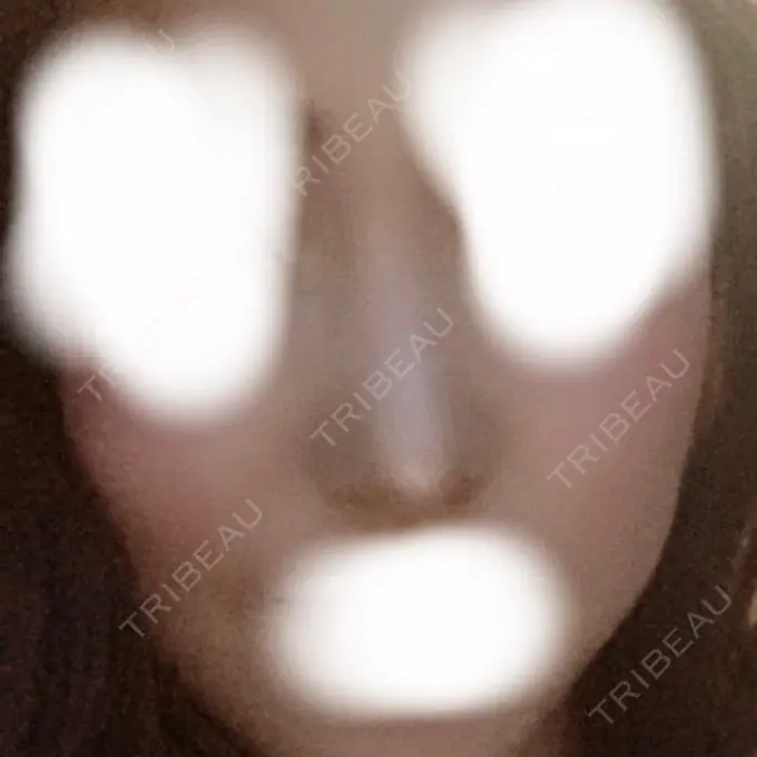 鼻尖形成（切開） / 鼻中隔延長（切開） / 軟骨移植 / 骨切幅寄せ / ワシ鼻修正・ハンプ切除 / 鼻尖縮小 / その他（鼻） ラミチェ美容整形外科 DAY 114 メイン用