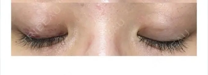 二重埋没 ルネッサンス美容外科医院 神戸院 DAY 1 メイン用