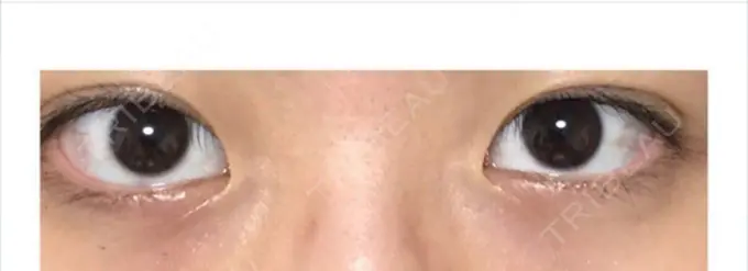 二重埋没 ルネッサンス美容外科医院 神戸院 AFTER メイン用