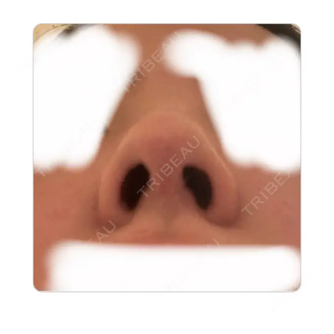 鼻尖形成（切開） / 鼻中隔延長（切開） / 軟骨移植 / 骨切幅寄せ / ワシ鼻修正・ハンプ切除 / 鼻尖縮小 / その他（鼻） ラミチェ美容整形外科 DAY 131 メイン用