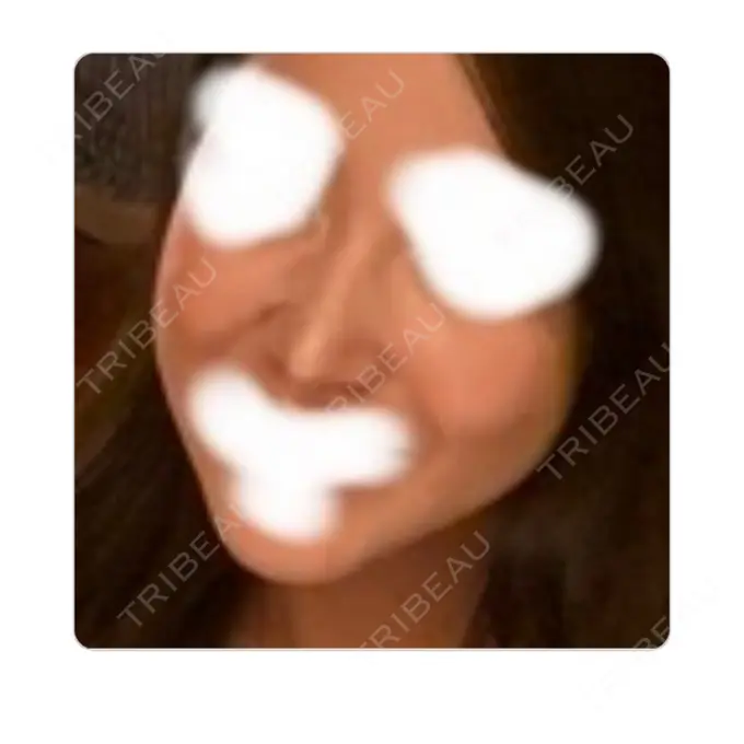 鼻尖形成（切開） / 鼻中隔延長（切開） / 軟骨移植 / 骨切幅寄せ / ワシ鼻修正・ハンプ切除 / 鼻尖縮小 / その他（鼻） ラミチェ美容整形外科 DAY 131 メイン用