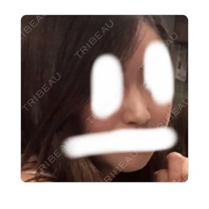 鼻尖形成（切開） / 鼻中隔延長（切開） / 軟骨移植 / 骨切幅寄せ / ワシ鼻修正・ハンプ切除 / 鼻尖縮小 / その他（鼻） ラミチェ美容整形外科 DAY 131 メイン用