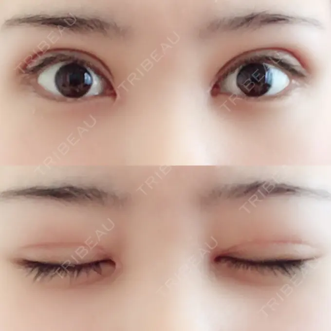 二重切開 / 目頭切開 城本クリニック 豊橋院 DAY 55 メイン用