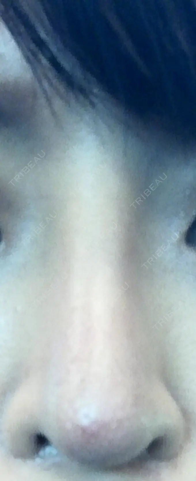 隆鼻術 / 鼻尖形成（切開） / 軟骨移植 ヤスミクリニック DAY 21 メイン用