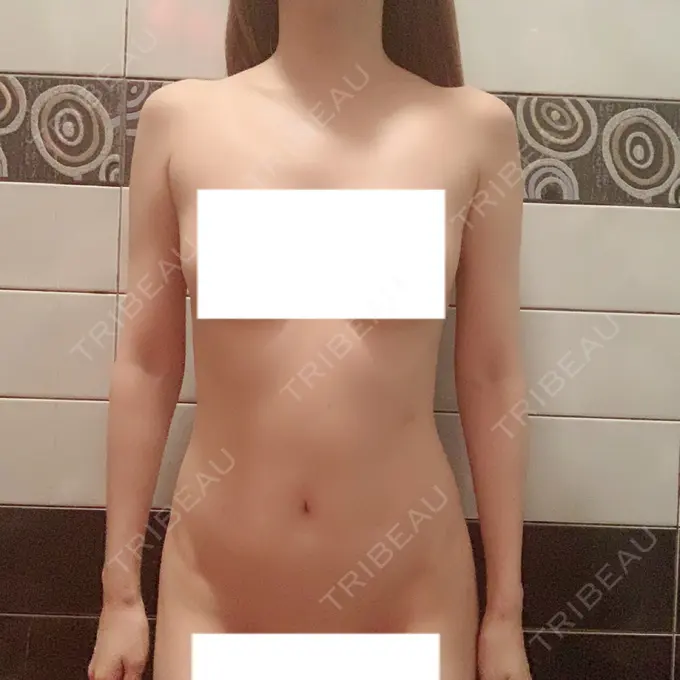 脂肪吸引（二の腕） / 脂肪吸引（お腹） / 脂肪溶解注射（二の腕） / 脂肪溶解注射（お腹） / その他（ボディ） THE SKINNY CLINIC（ザ・スキニークリニック） DAY 131 メイン用