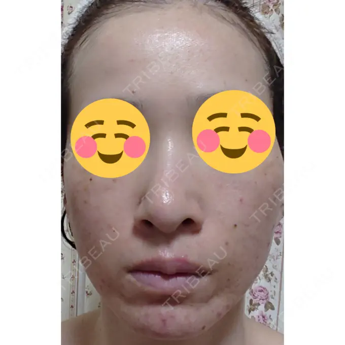 ほくろ・いぼ除去レーザー（肌） 広島プルミエクリニック DAY 1 メイン用