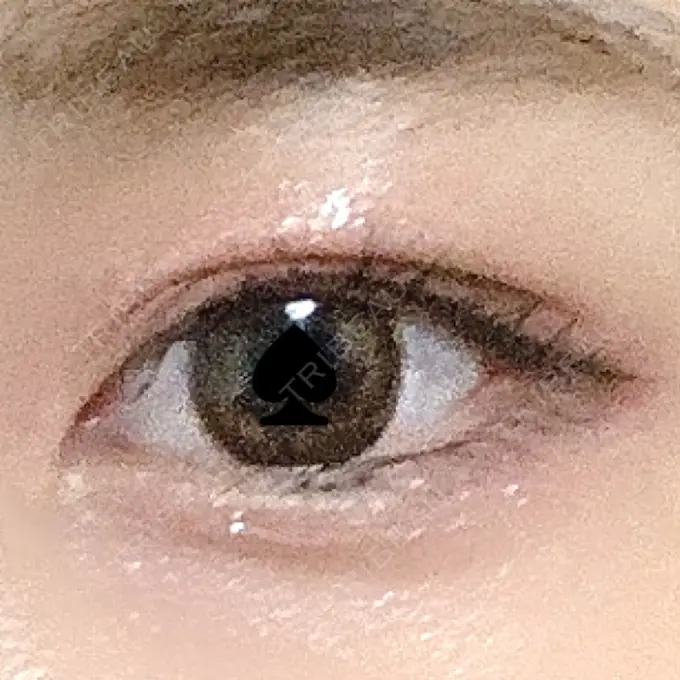 二重切開 よこはまエーブクリニック DAY 107 メイン用