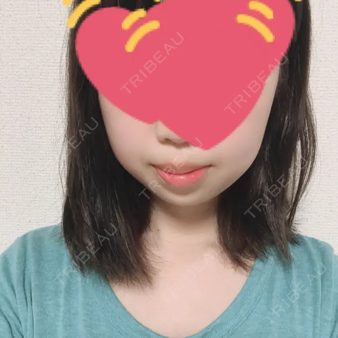 ボトックス（あご） 恵聖会クリニック 京橋院 DAY 2 メイン用