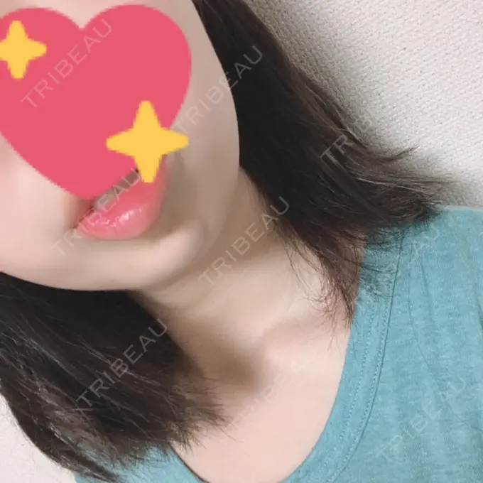 ボトックス（あご） 恵聖会クリニック 京橋院 DAY 2 メイン用