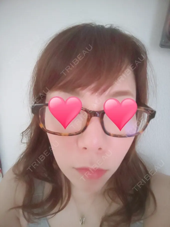 隆鼻術 品川スキンクリニック岡山院 DAY 51 メイン用