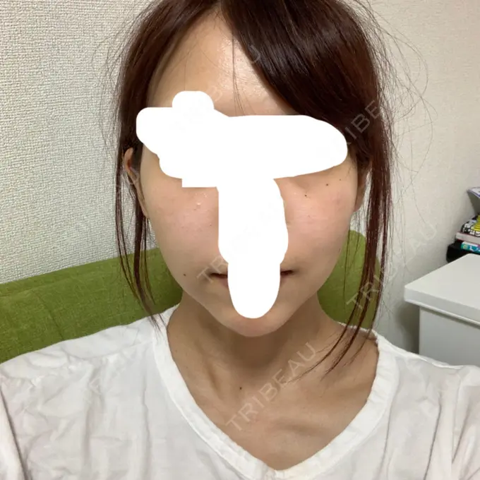 バッカルファット除去 / 脂肪吸引（顔） / ハイフ（顔） THE PLAN（ザ・プラン）美容整形外科・皮膚科 DAY 19 メイン用