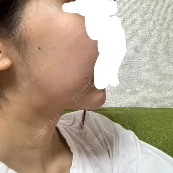 バッカルファット除去 / 脂肪吸引（顔） / ハイフ（顔） THE PLAN（ザ・プラン）美容整形外科・皮膚科 DAY 19 メイン用