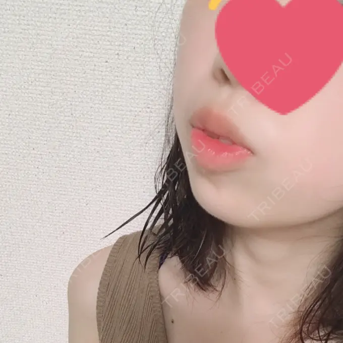 ボトックス（あご） 恵聖会クリニック 京橋院 DAY 3 メイン用