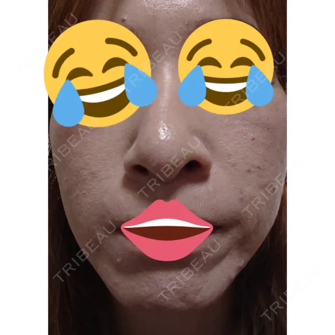 ほくろ・いぼ除去レーザー（肌） 広島プルミエクリニック DAY 3 メイン用