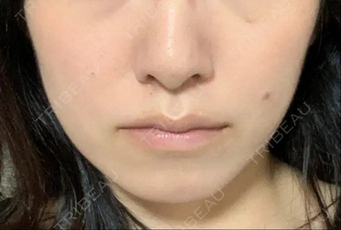 ボトックス（エラ・小顔） TCB東京中央美容外科 郡山院 DAY 90 メイン用