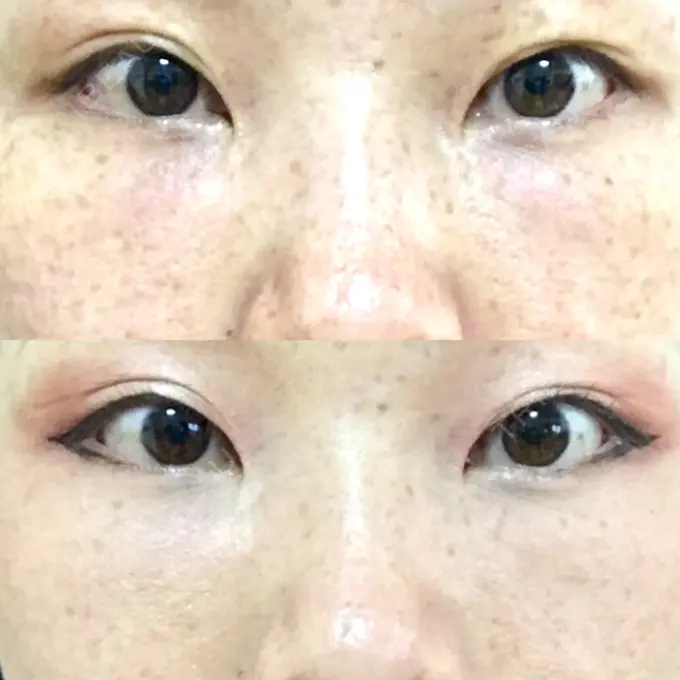 下まぶたたるみ取り / 下まぶたの脂肪取り 韓国ST美容整形外科 DAY 47 メイン用