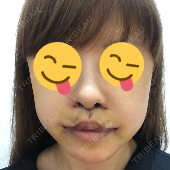 人中短縮 / 口角挙上 清潭女神美容外科 DAY 4 メイン用