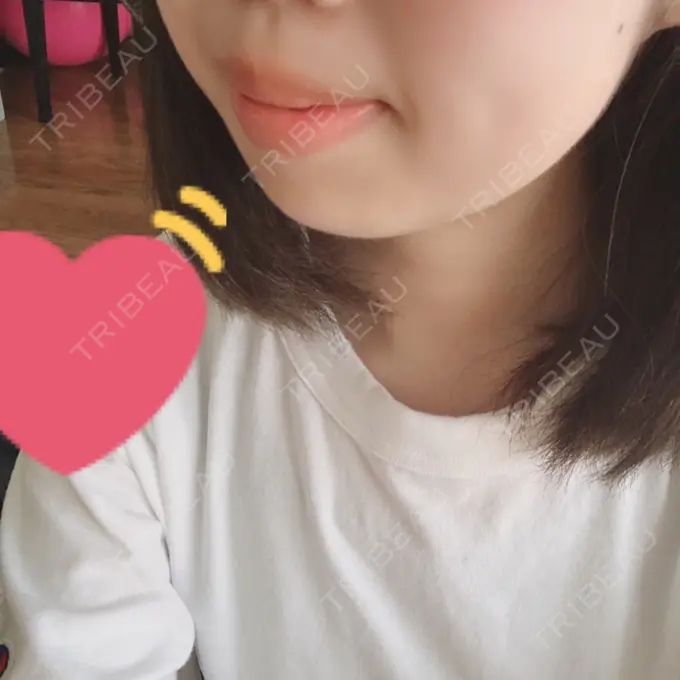 ボトックス（あご） 恵聖会クリニック 京橋院 DAY 4 メイン用