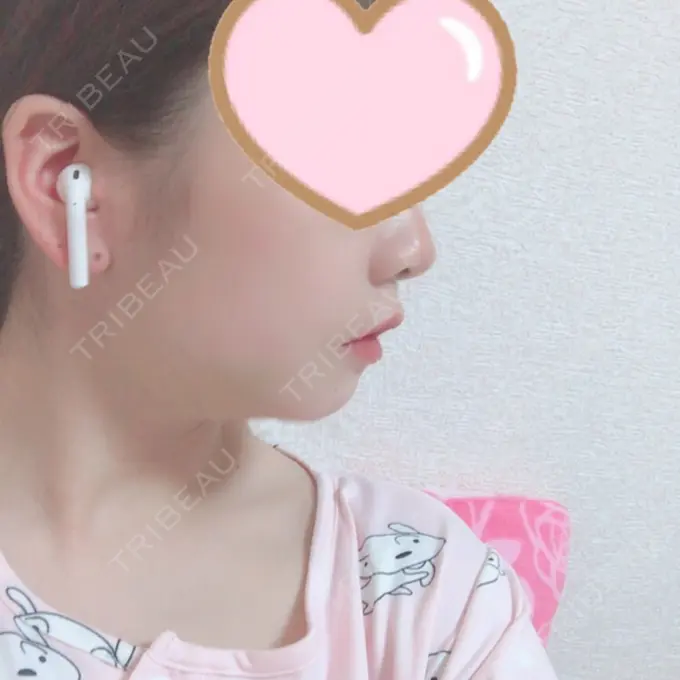 セットバック 大塚美容形成外科・歯科 大塚本院 DAY 13 メイン用