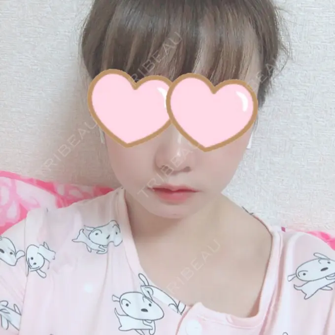 セットバック 大塚美容形成外科・歯科 大塚本院 DAY 13 メイン用